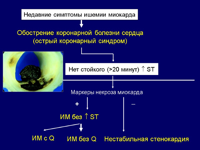 Недавние симптомы ишемии миокарда Нет стойкого (>20 минут)  ST Маркеры некроза миокарда ИМ